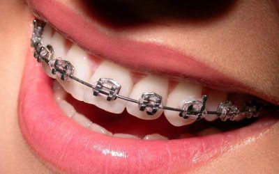 Life with Braces: Tips for Eating, Cleaning, and Smiling with Confidence