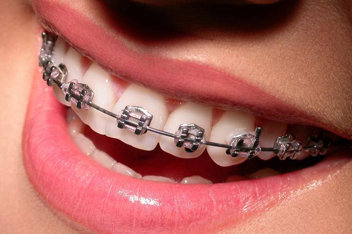 Life with Braces: Tips for Eating, Cleaning, and Smiling with Confidence